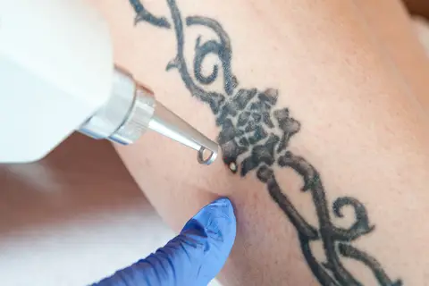 Tattoo- und PMU-Entfernung