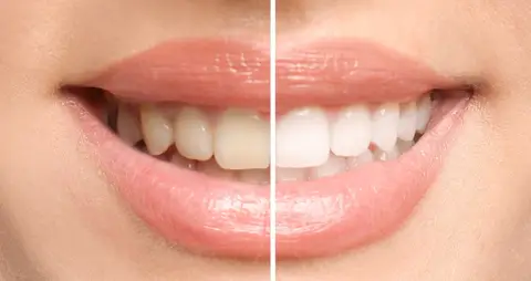 Kosmetisches Zahnbleaching